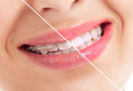 Photo showing braces on a dental patient.