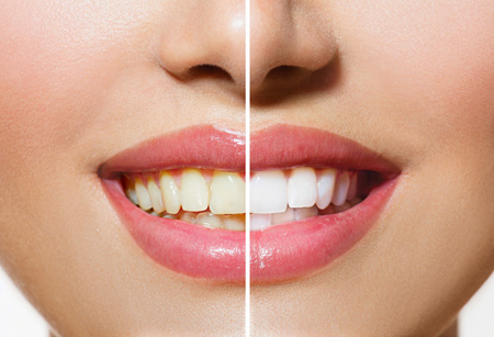 Patient with before & after whitening treatment on teeth.